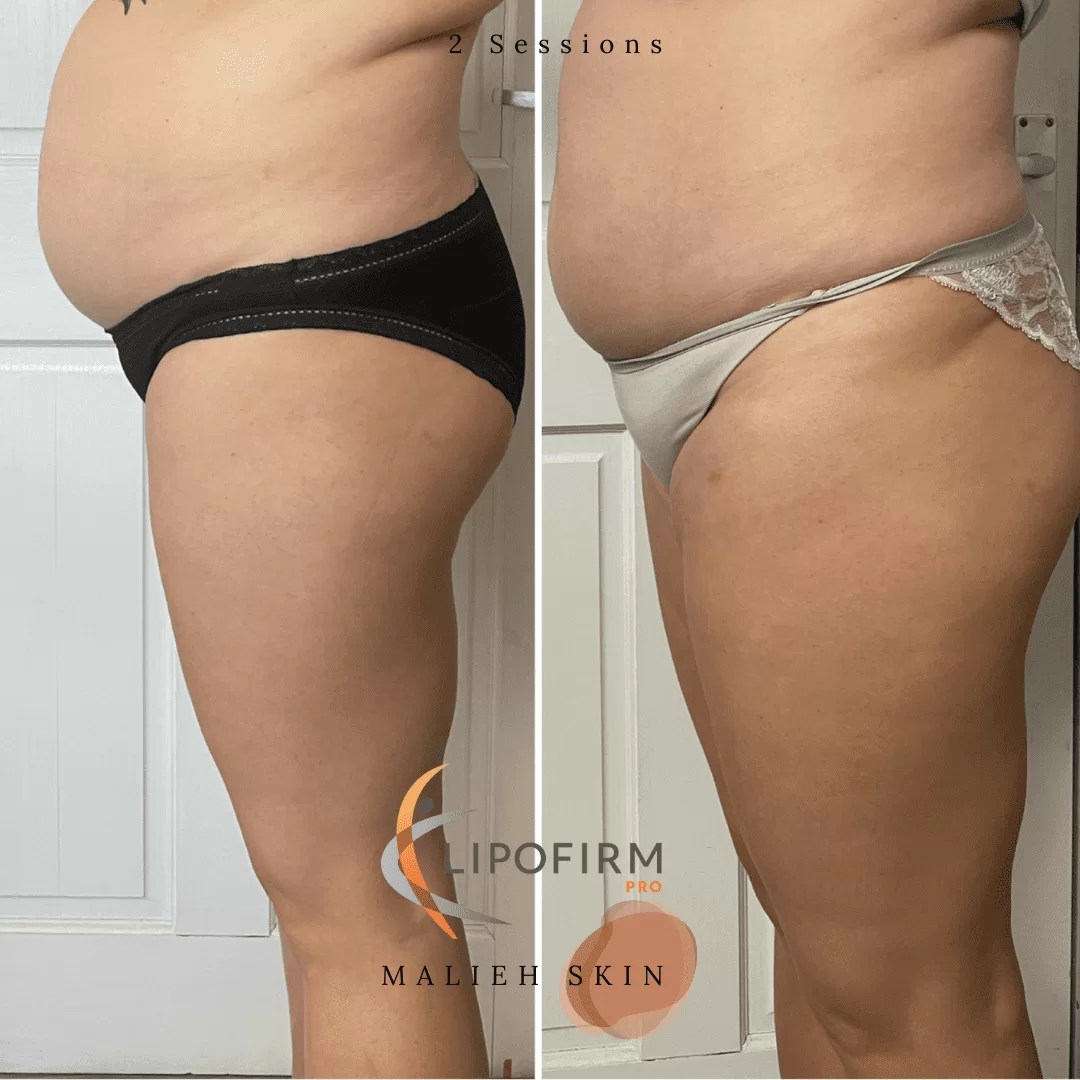 Lipofirm Pro Malieh Skin