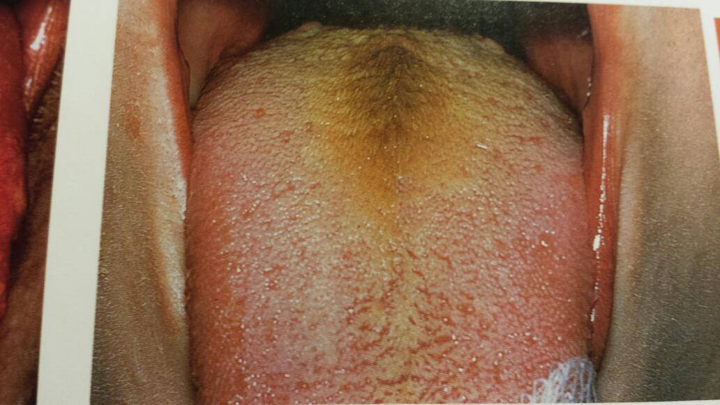 You Can't Ignore These Things Your Tongue is Warning You About