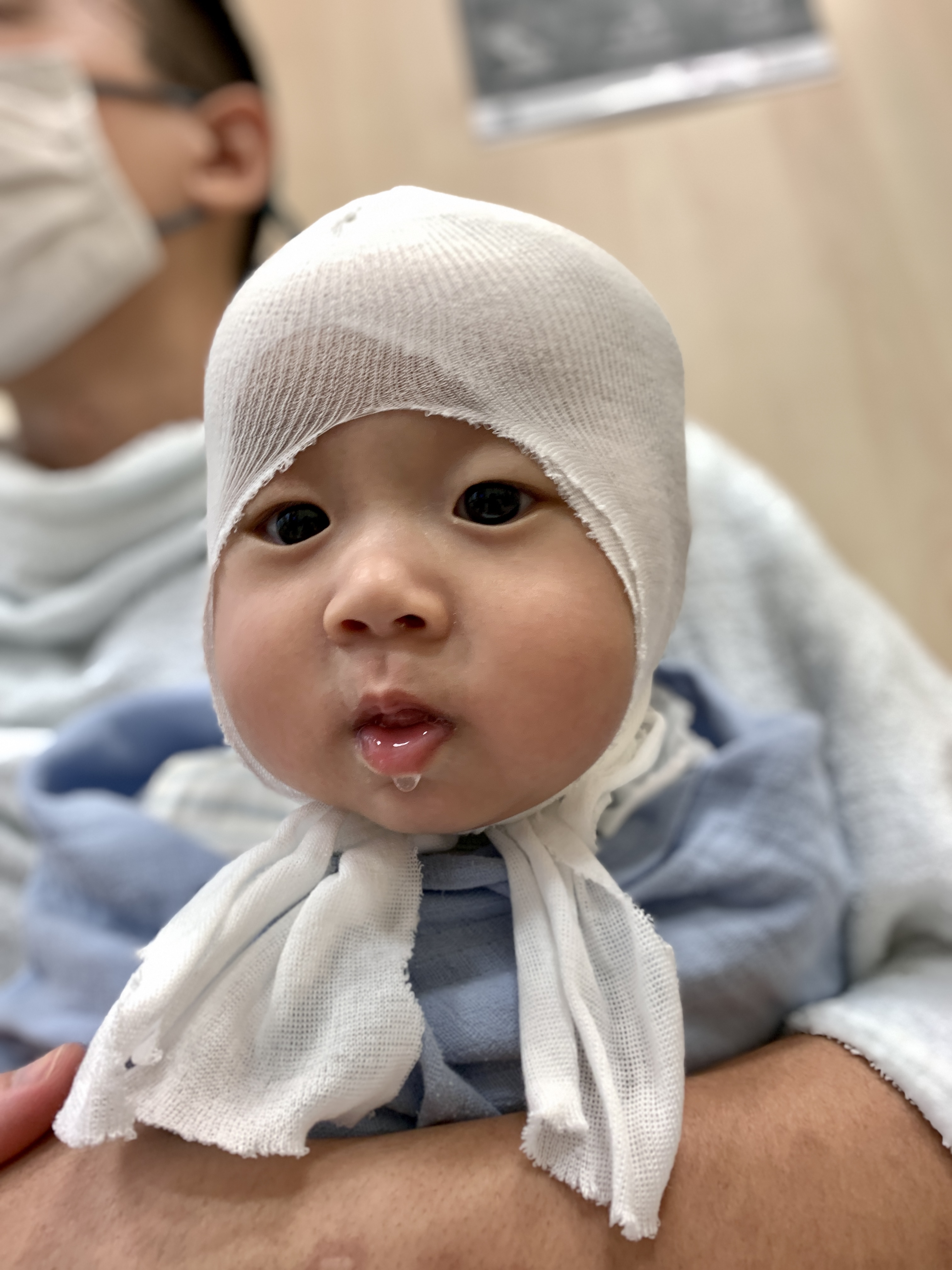 Helmet Therapy in Singapore, Plagiocephaly Flat Head Baby