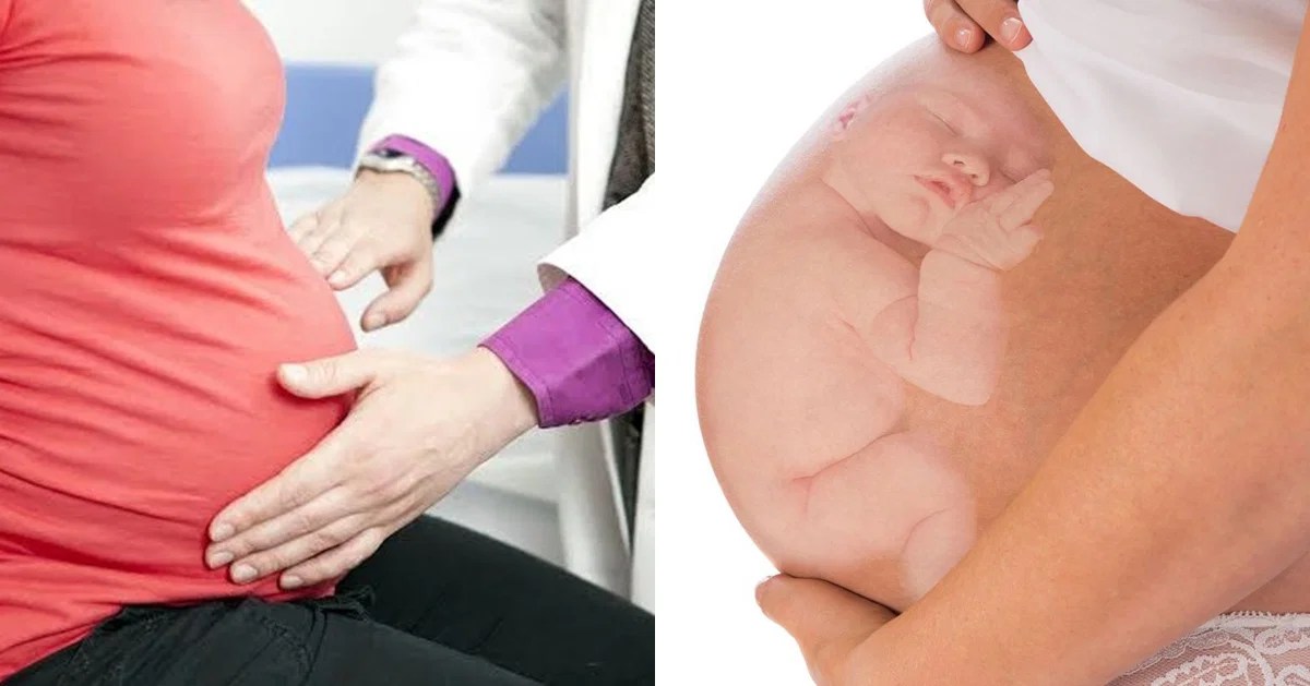 Bayi Sungsang, Ini 6 Penyebab dan Cara Mengatasi Posisinya