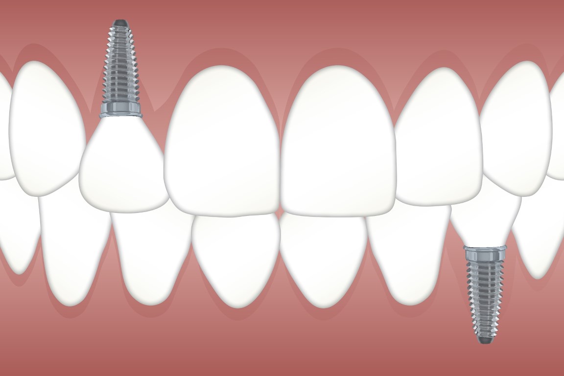 How Strong Are Dental Implants in Comparison to Real Teeth?
