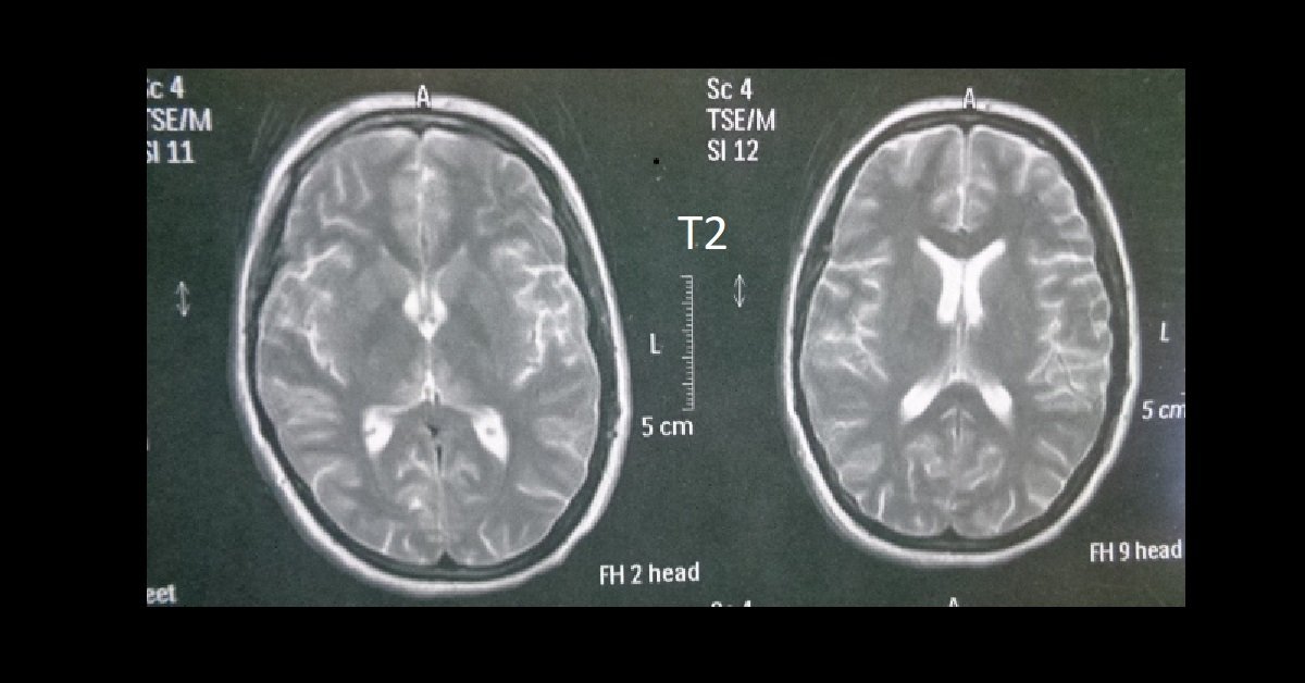 WernickeKorsakoff’s Encephalopathy (Thiamine Deficiency) Manal's