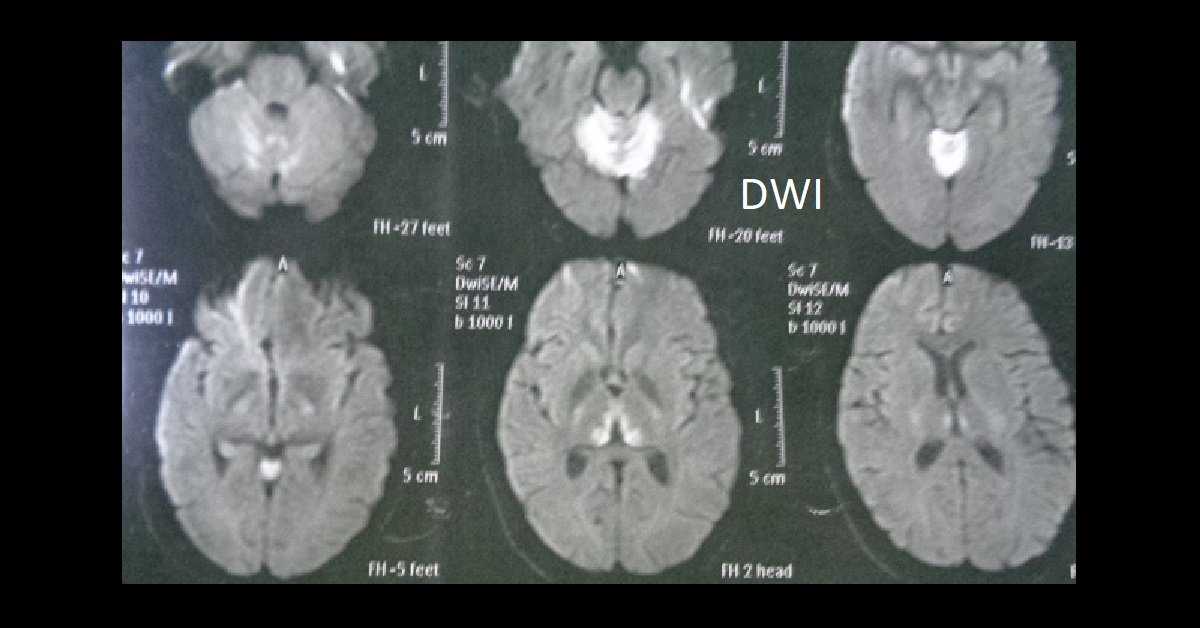 Thiamine Deficiency Mri Brain