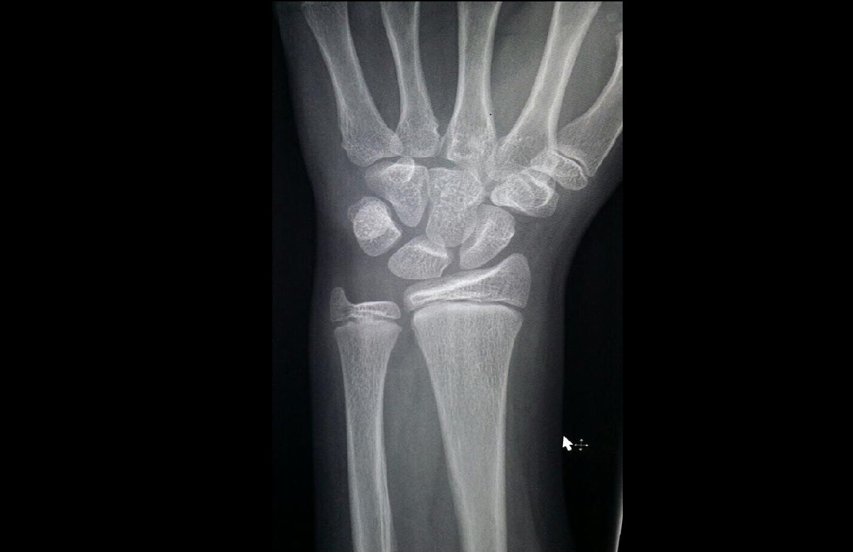 Torus Fracture Definition Causes Diagnosis Torus Fracture Treatment Images