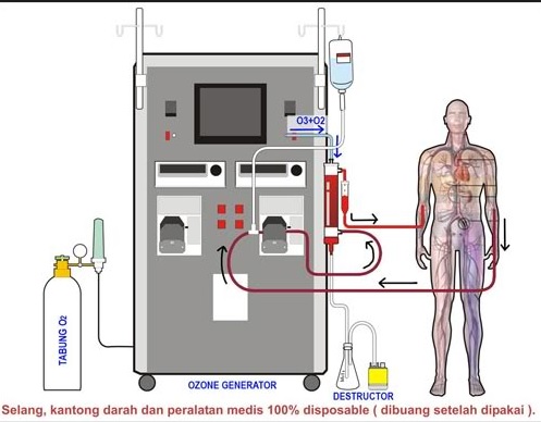 13 Manfaat Terapi Ozon Bagi Kesehatan - Manfaat.co.id