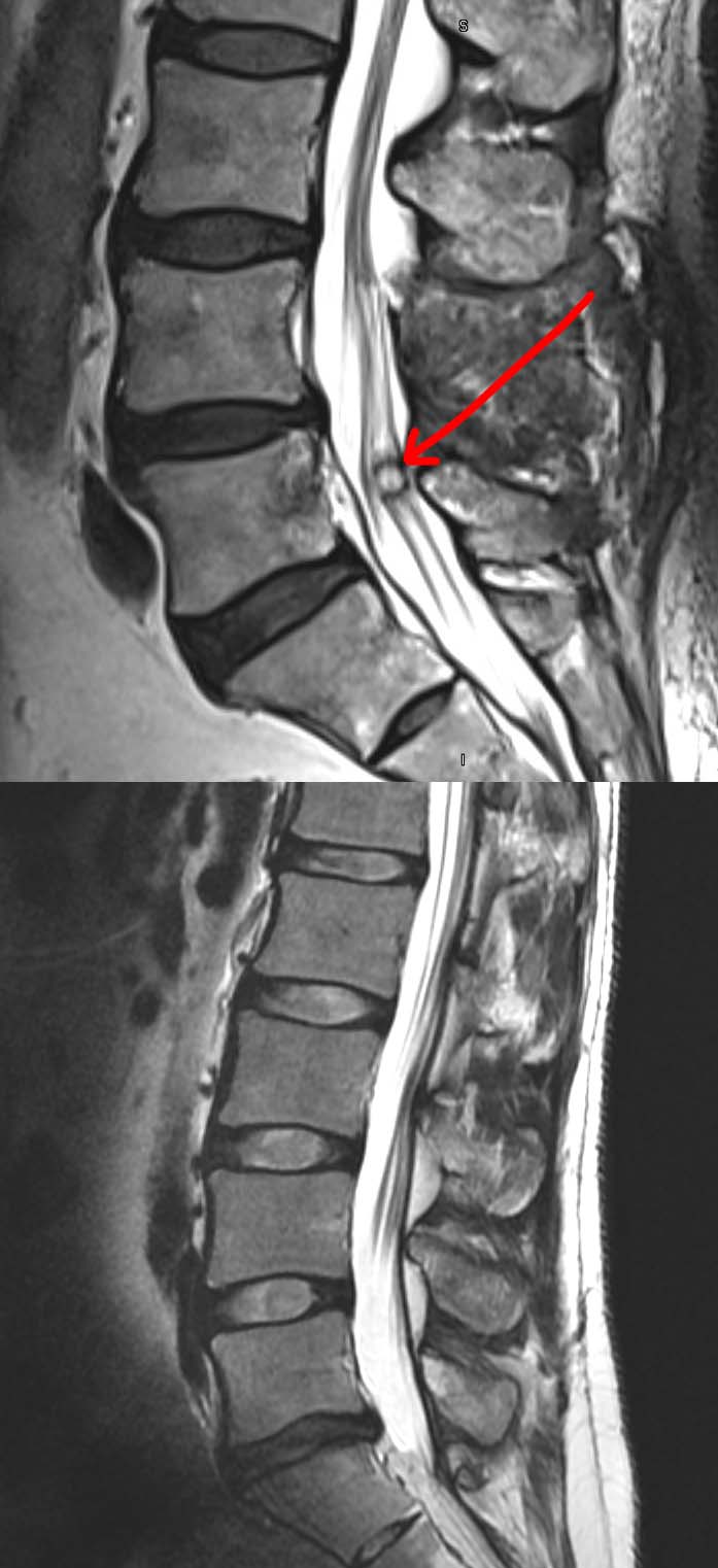 Synovial Cyst Histology