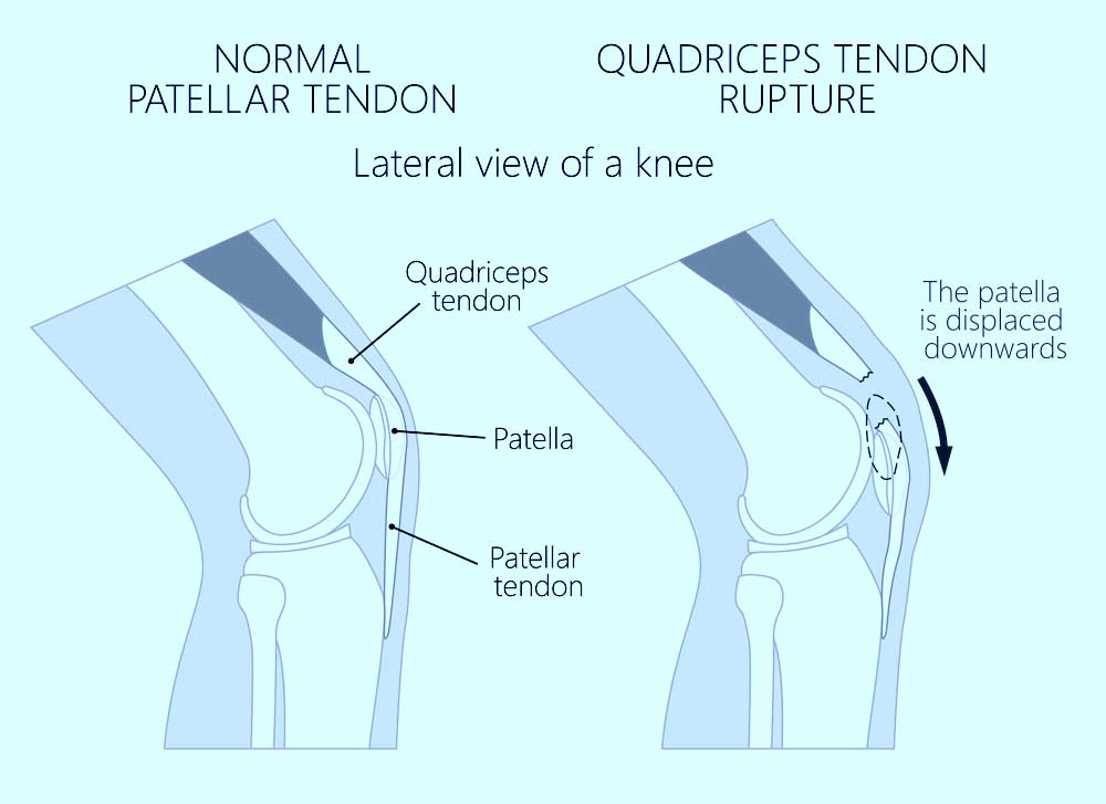 Quadriceps Tendon Rupture Repair Surgery Orthopedic Knee Surgeon