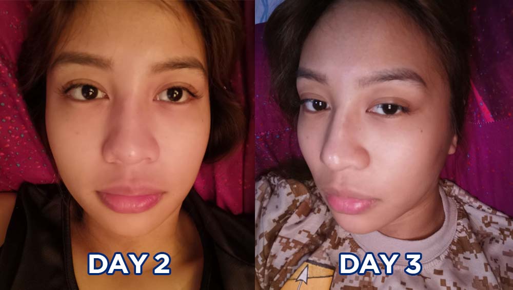 Nonsurgical NOSE JOB for Asians What I went through to get a nose