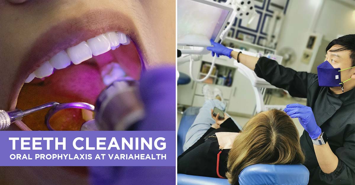 Teeth cleaning or Oral Prophylaxis How often should you go to the