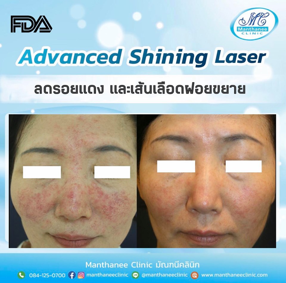 ADVANCED SHINING LASER WITH DUAL YELLOW Services Manthanee Clinic