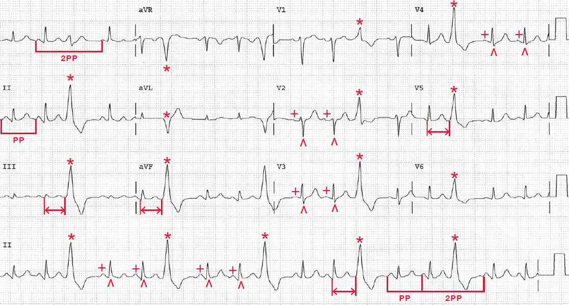 Premature Ventricular Contractions (PVCs) ECG (Example 3), 50 OFF
