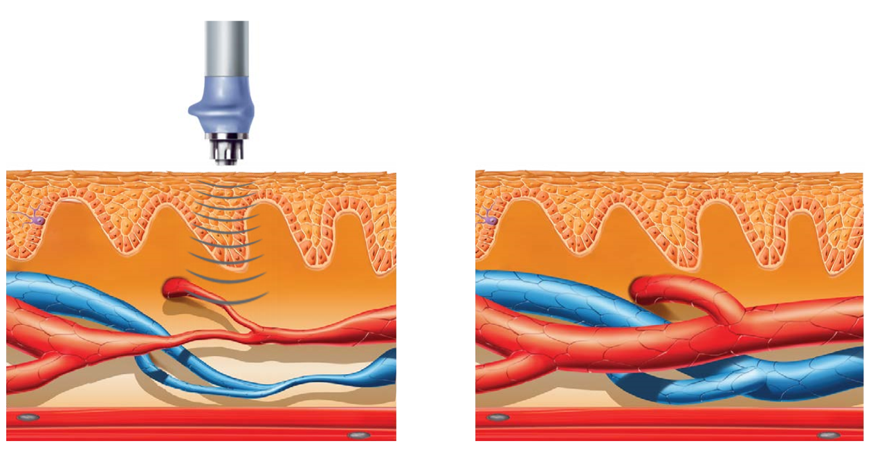 Shockwave Therapy Maple Ridge Physiotherapy & Pain Clinic