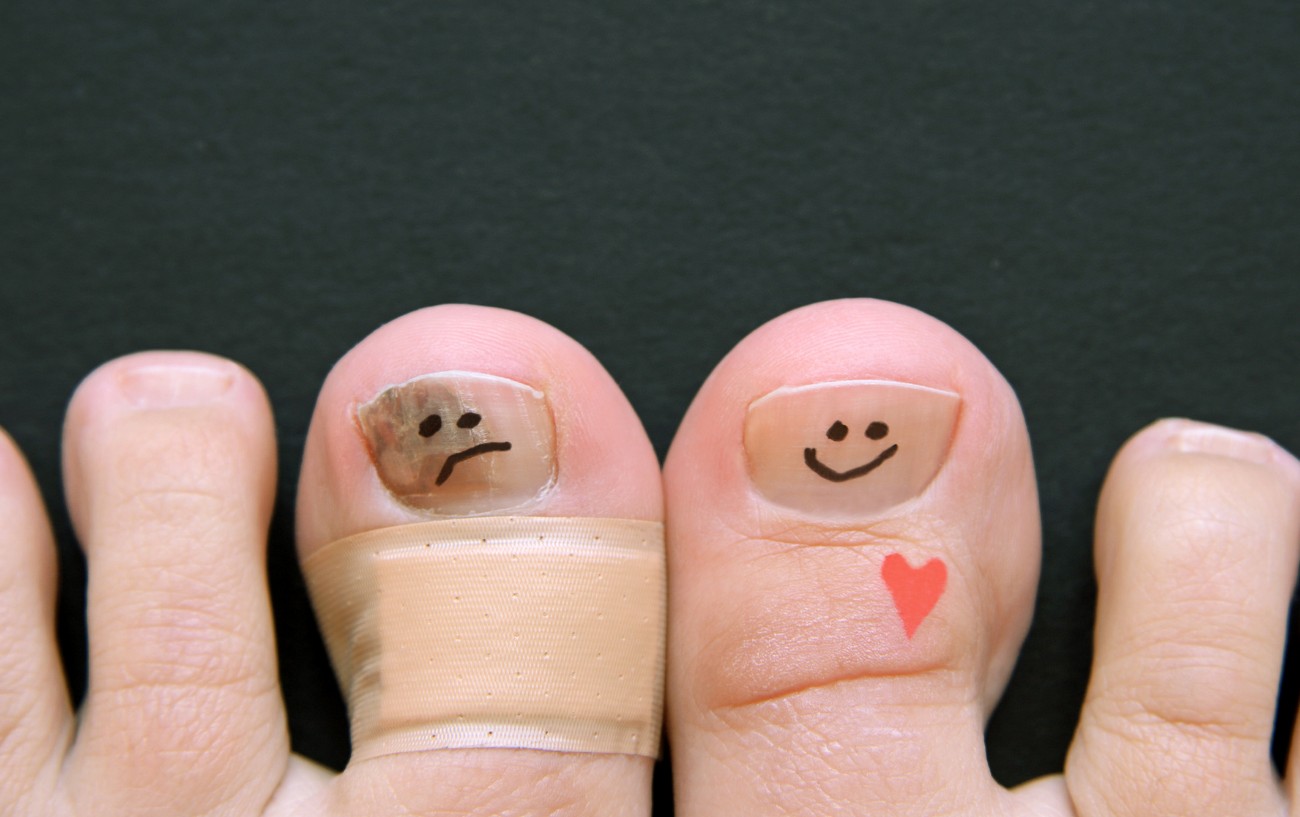 Bruised Toenail From Running? What To Do About Runner's Toe