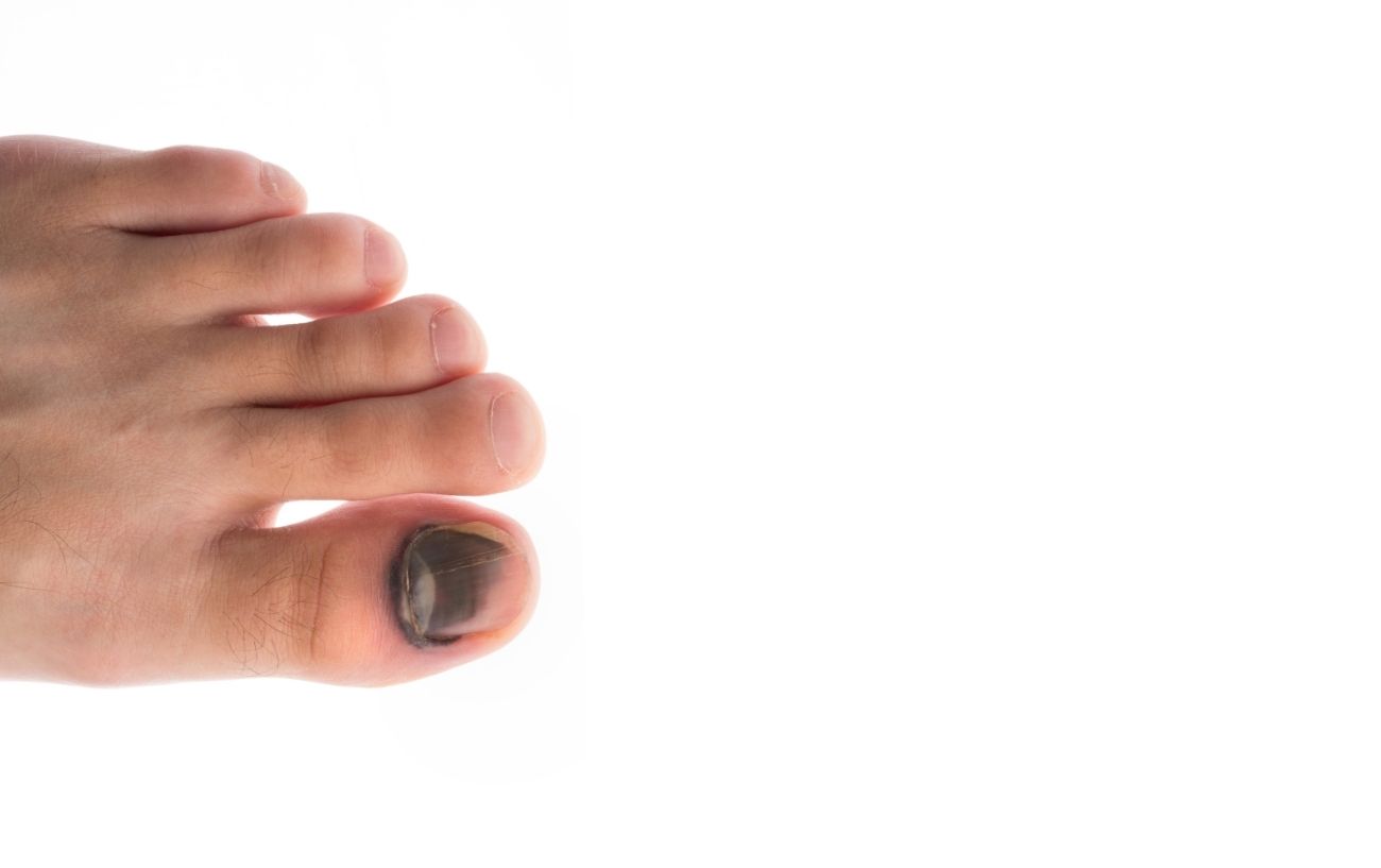 Runner's Toe Causes, Symptoms, And Prevention