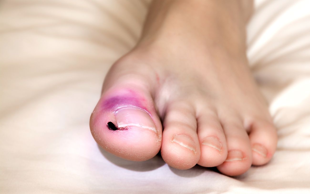 Stubbed Toe Treatment When Do You Need To Seek Help?