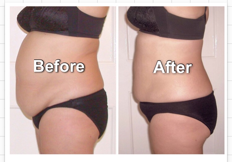 Know the benefits and How Laser Liposuction Really Work! Food for