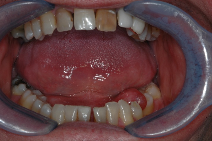 Aspetti Morfologici Benigni Della Mucosa Orale Dott Mariani Umberto Patologia Orale E Medicina