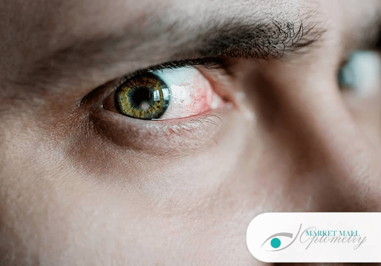 Eye Discharge What It Means And How To Address It Optometry Calgary