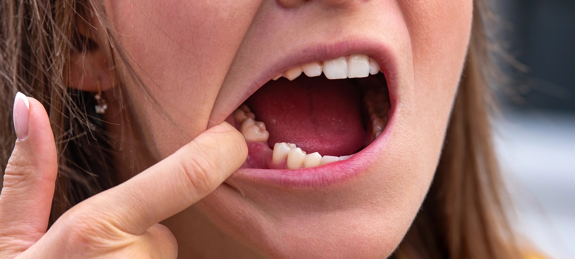 Preventing Dry Socket After Tooth Extraction Essential Tips