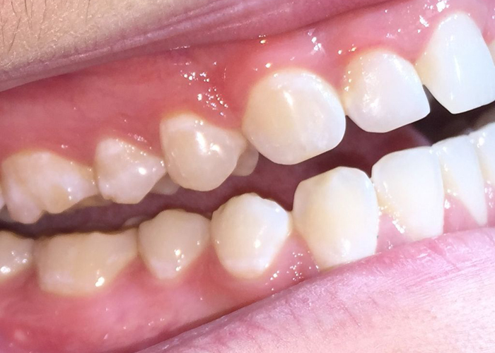 Bruxism (Habitual Grinding of Teeth) Mark DDS