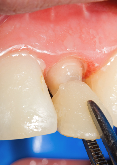 Porcelain Veneers Post Operative Instructions Mark DDS