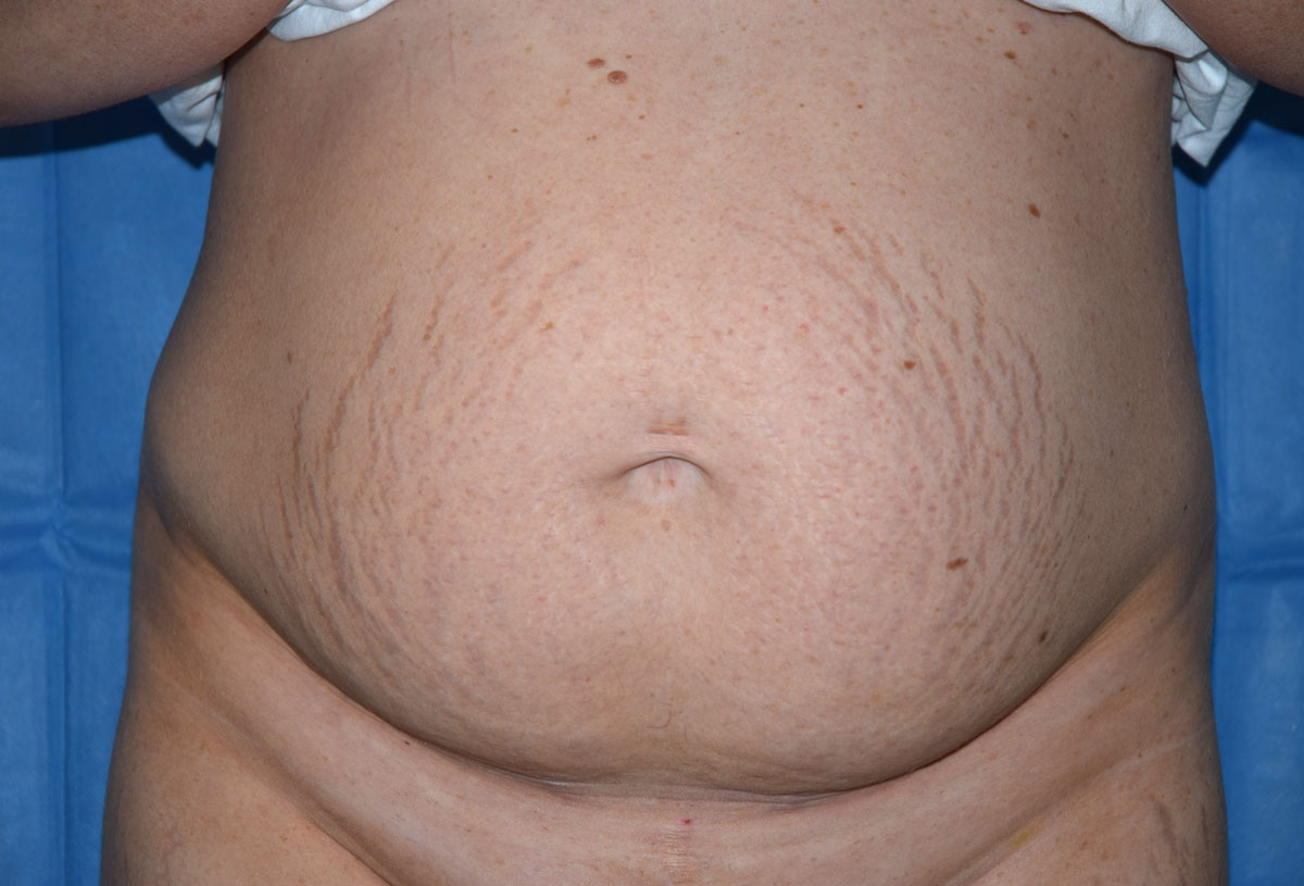 Tummy Tuck A/Prof Mark Gianoutsos