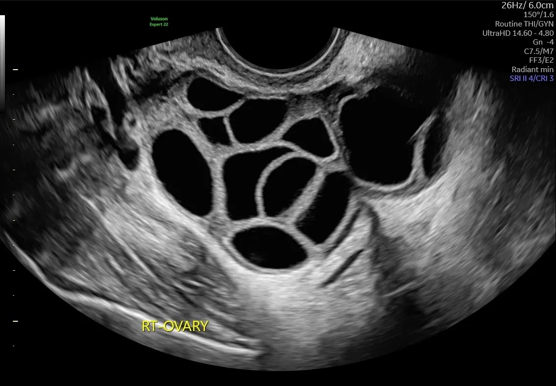 Services Follicle Tracking Ultrasound Markham Fertility Centre