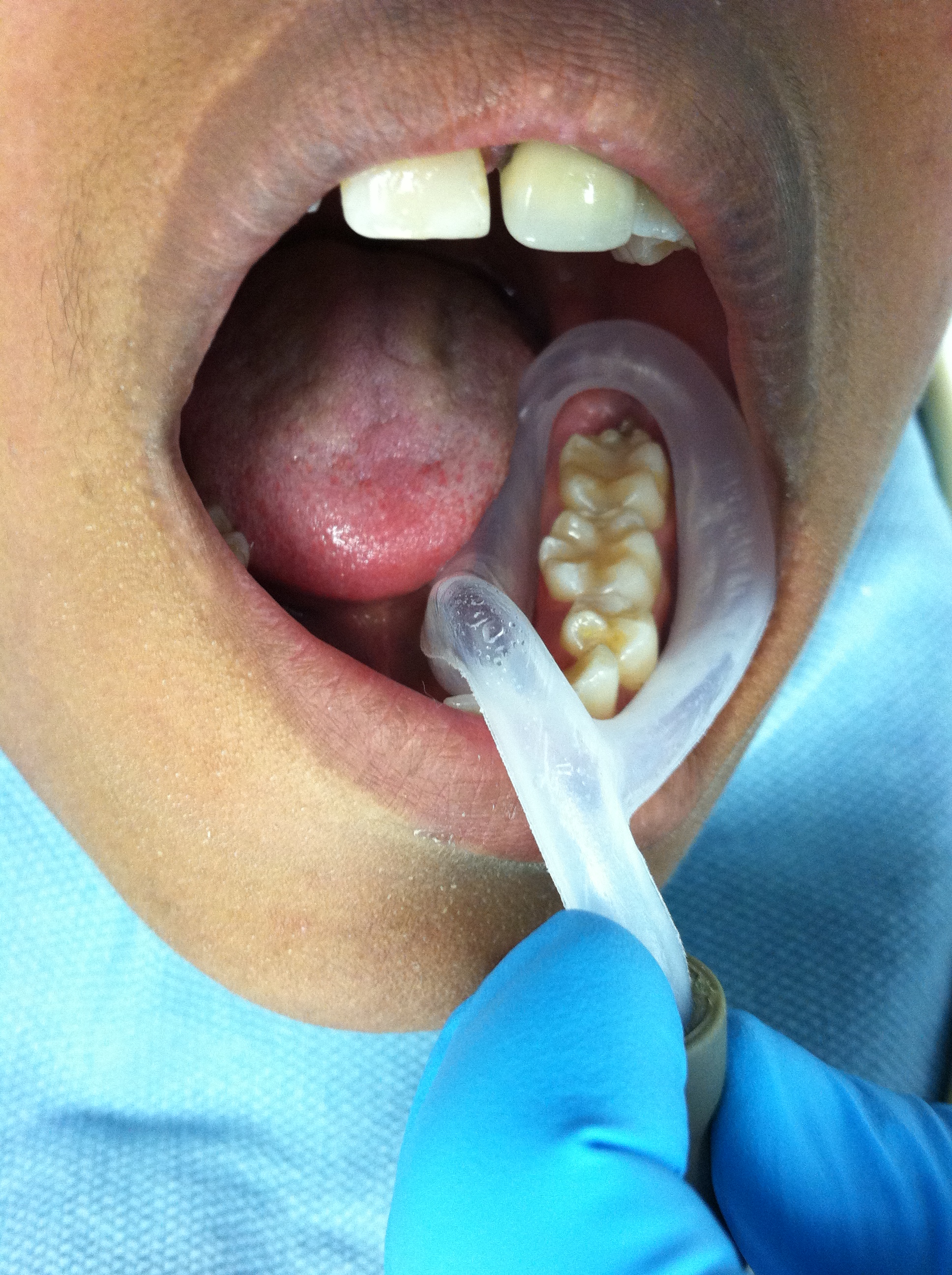 The standard saliva ejector is just not enough Mark Frias, RDH