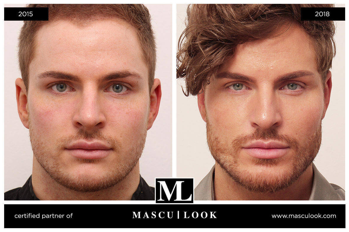 Jawline Behandlung für den Mann MascuLook Dr. Djalaei