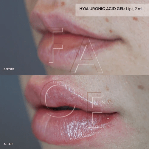 How to Massage Away Filler Bumps Under Eyes A StepbyStep Guide