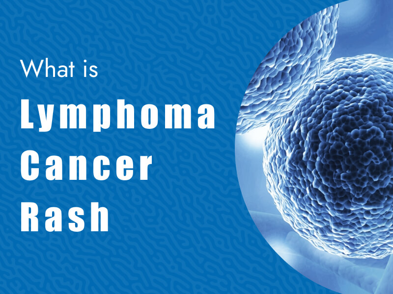 What is Lymphoma Cancer Rash? Massive Bio