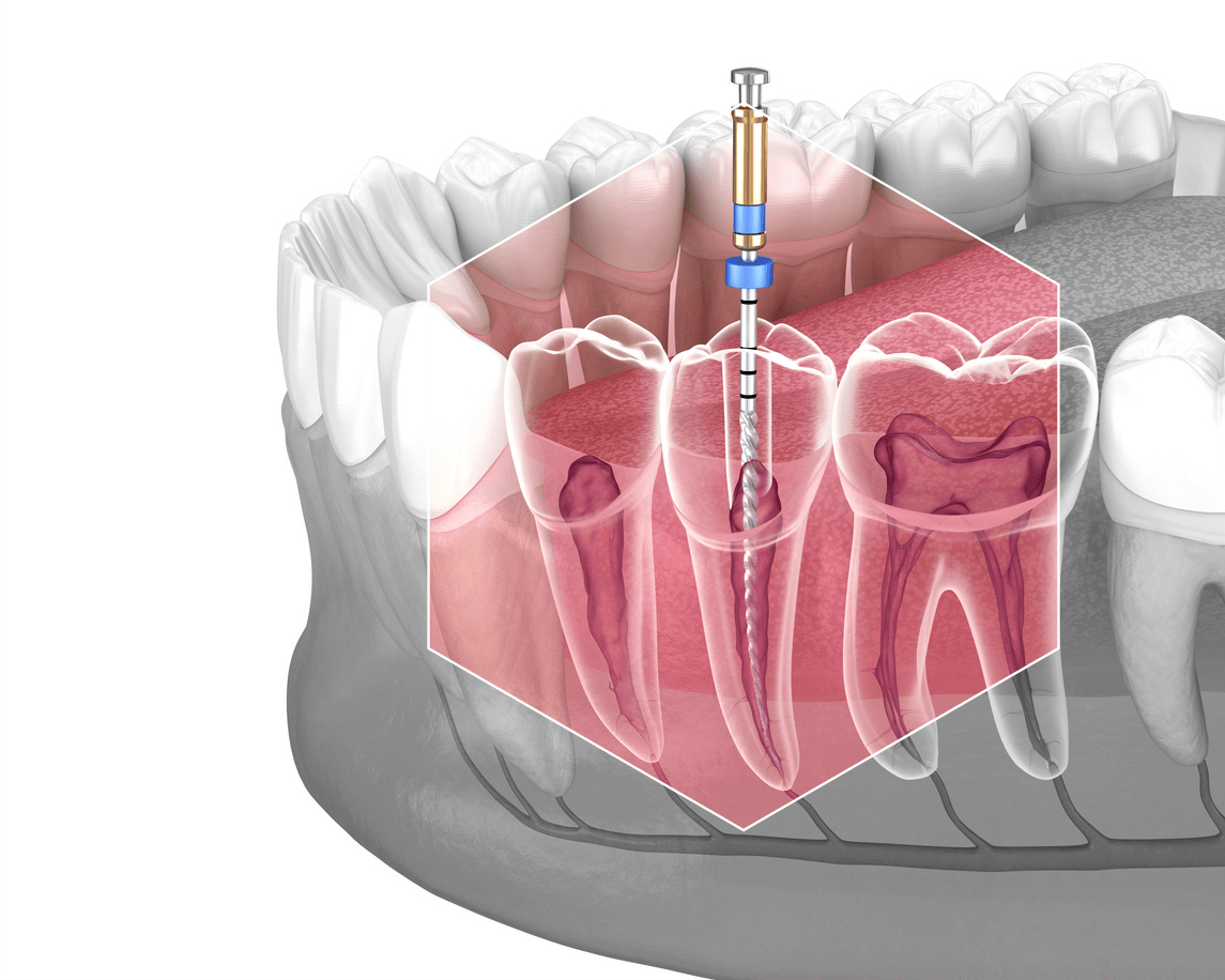 Que és la Endodoncia? Endodoncistas Masterdoc24
