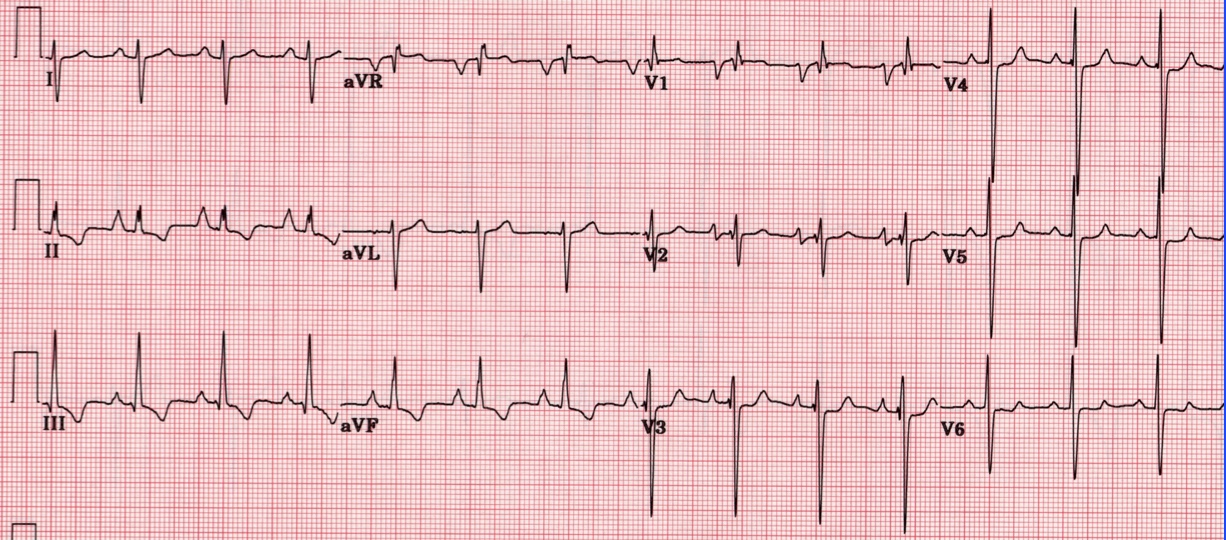 Borderline Right Axis Deviation Ecg Article Blog