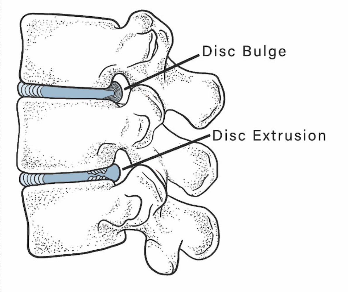 Disc Injury MASTERY MEDICAL