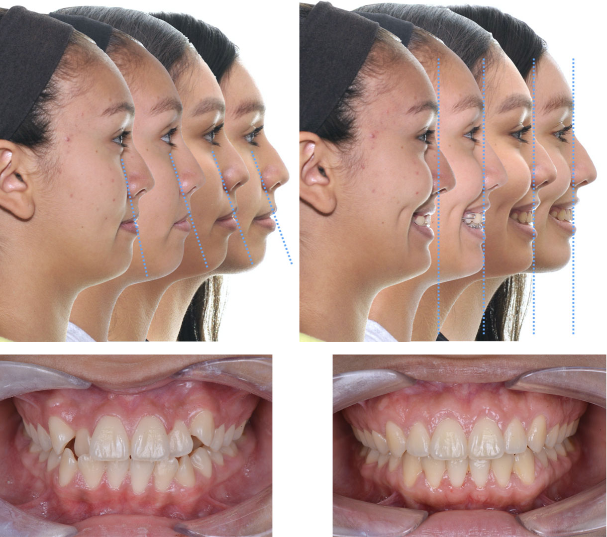 BeforeandAfter Braces & Invisalign Matsumoto Orthodontics