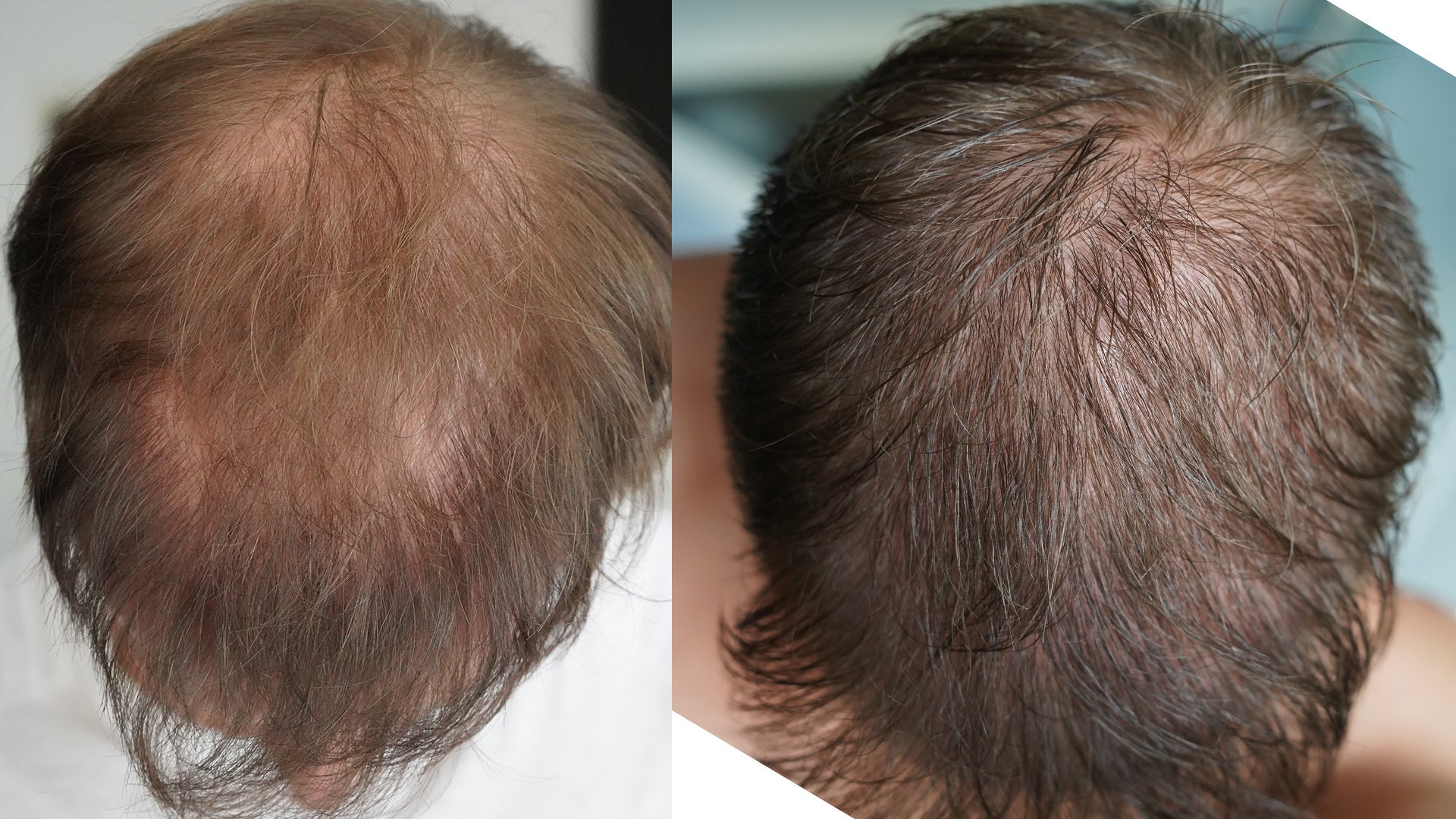 Matt Dominance shares his 2nd Hair Transplant Experience