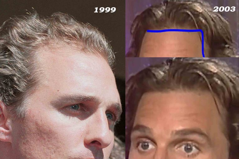 Matthew McConaughey Hair Loss Secrets Revealed!