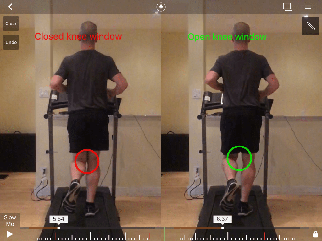 Running with Knock Knees Matthew Boyd Physio