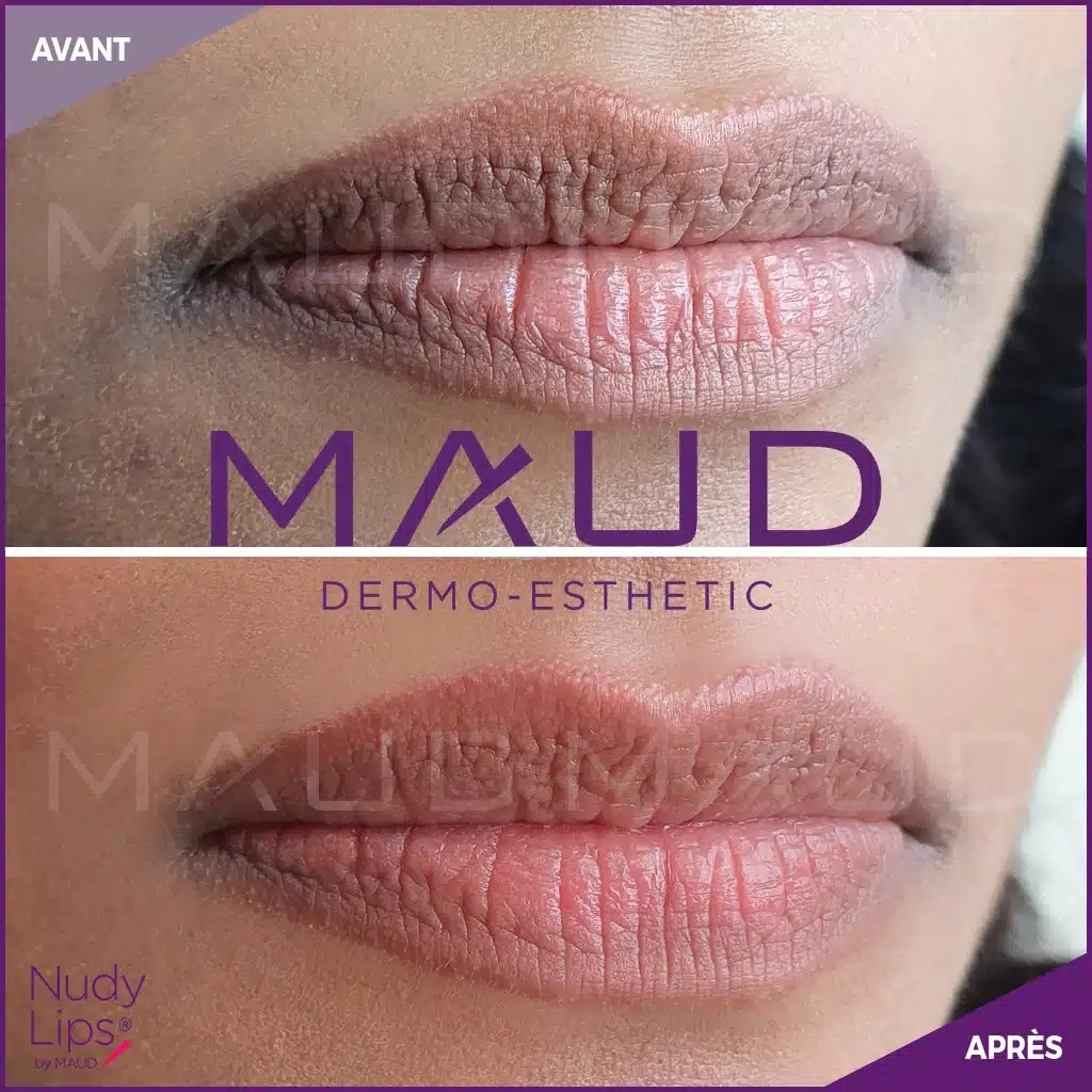Nudy Lips MAUD DermoEsthetic®