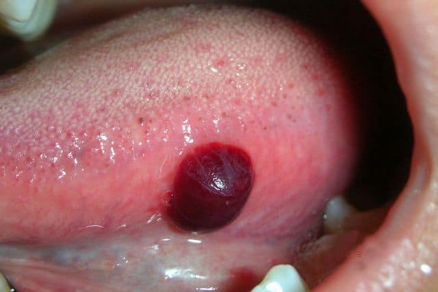 Blood Blister In The Mouth And Cheek Causes, Home Remedies