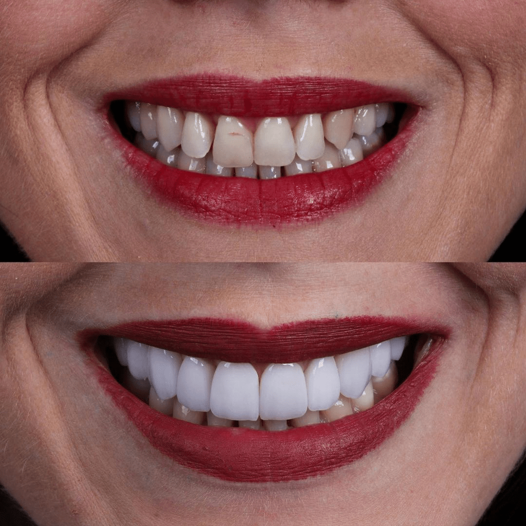 Dental Implants In Turkey HighQuality And Affordable 2024