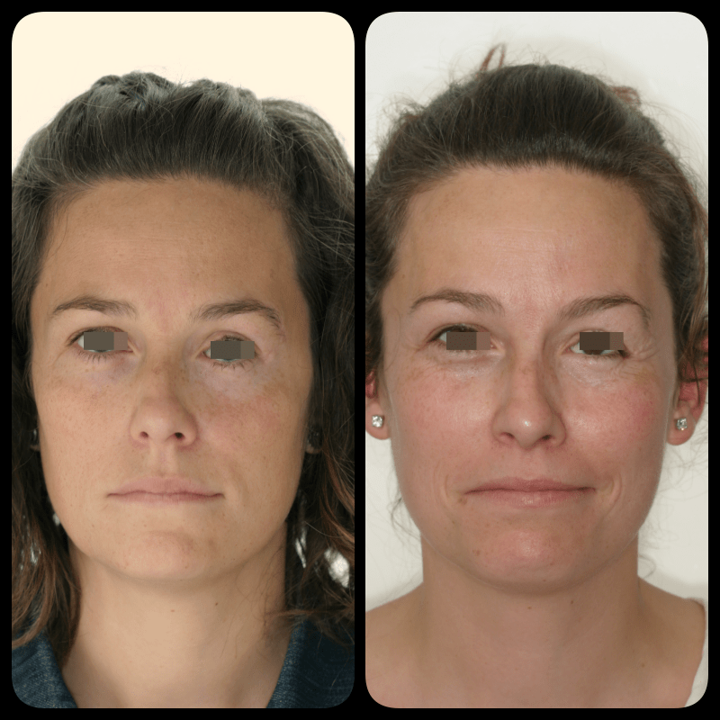 saltar Caprichoso persecucion dolor en el ojo y pomulo navegación