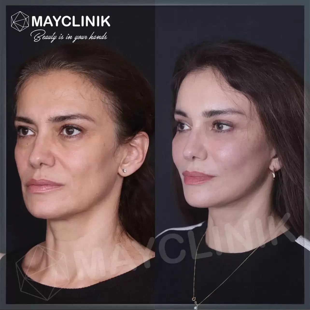 Deep Plane Facelift in Turkey Costs 2024 Mayclinik