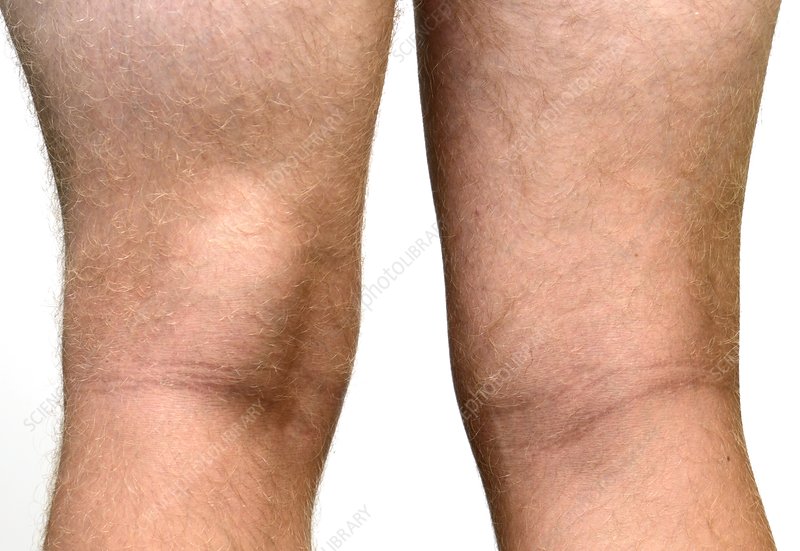 Baker’s Cyst Knee Mayfair Wellness Clinic
