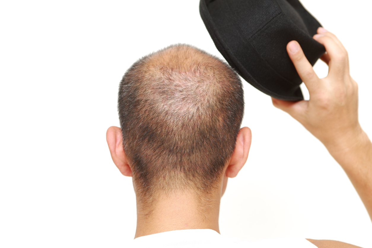 Do Hats Cause Hair Loss? Mccracken Eye And Face Institute