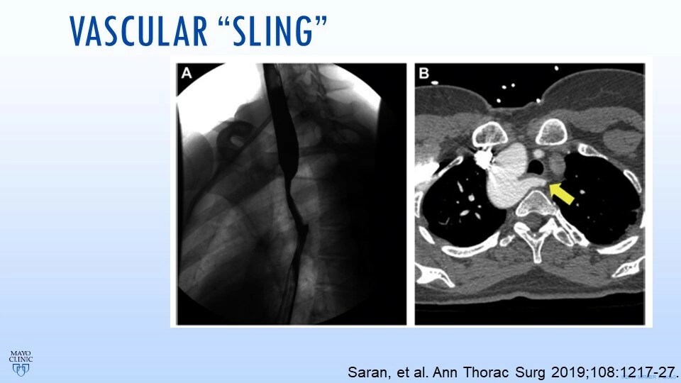 Vascular Rings and Slings Mayo Clinic Cardiovascular CME