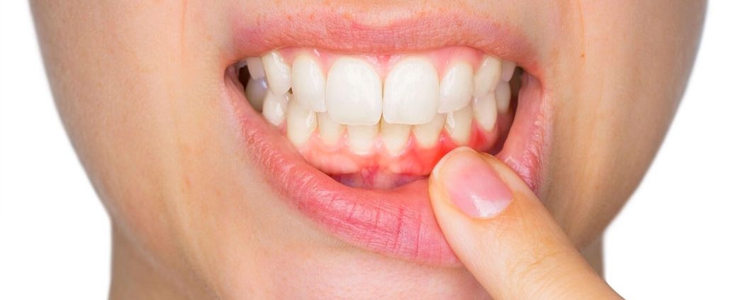 The Basics You Should Know About Mouth Sores Oral and Maxillofacial