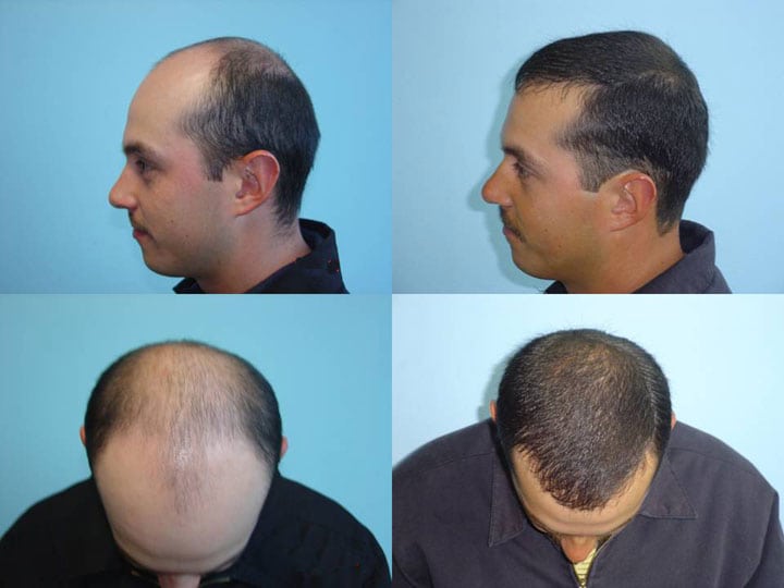Hair Transplant Alaska Serving Anchorage and Fairbanks Mcgrath Medical