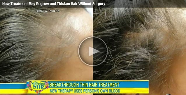 New Treatment May Regrow and Thicken Hair Without Surgery News