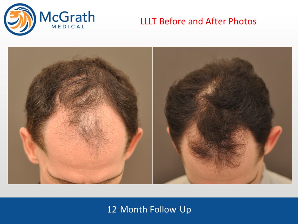 Capillus Laser Hair Therapy Austin, TX McGrath Medical